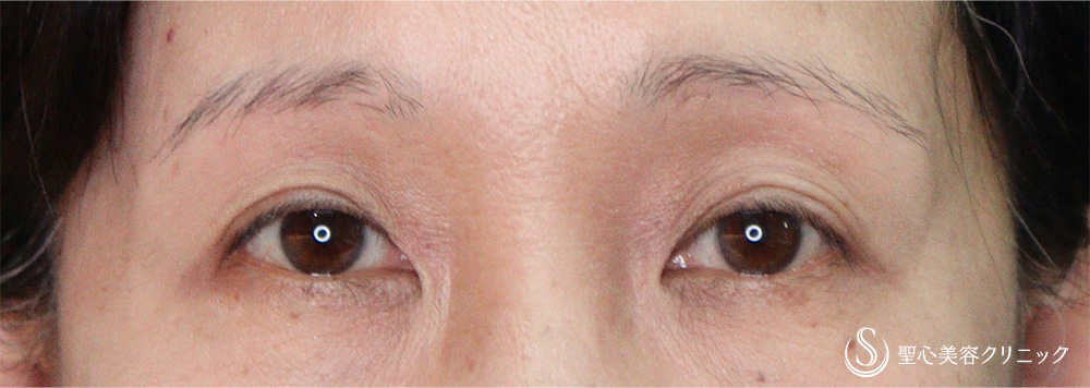 【50代女性・まぶたのたるみ、左右差】眉下切開法（眉下リフト）（11ヶ月後） After 