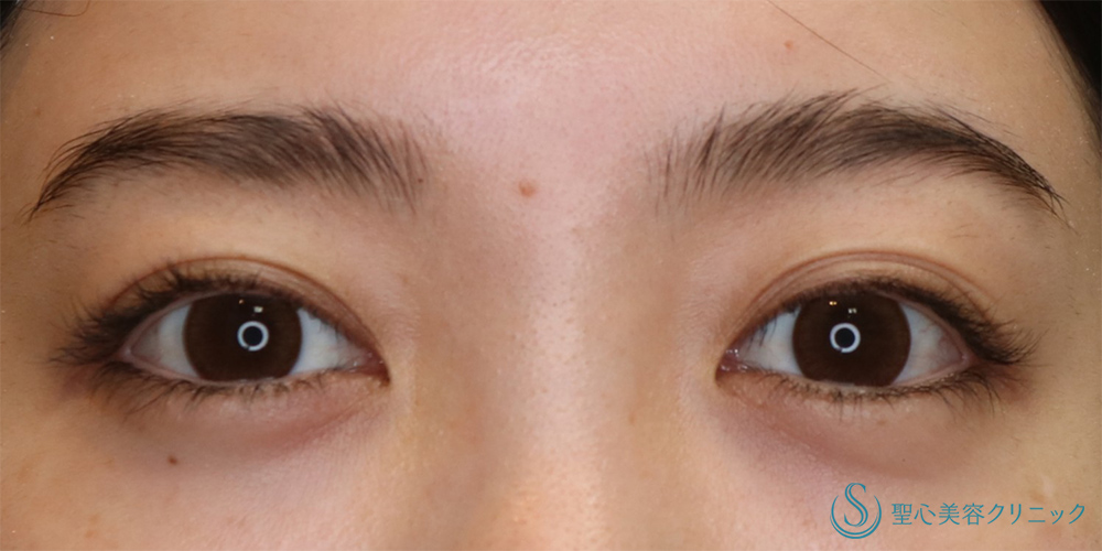 【20代女性・左右差を揃えパッチリした目元に】二重全切開＋脱脂（6ヶ月後） Before 