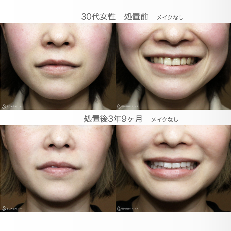 【30代女性・法令線（貴族注射）＆小顔リフト】プレミアムPRP皮膚再生療法→デンシティ＆ボトックスリフト（3年9ヶ月後） After 
