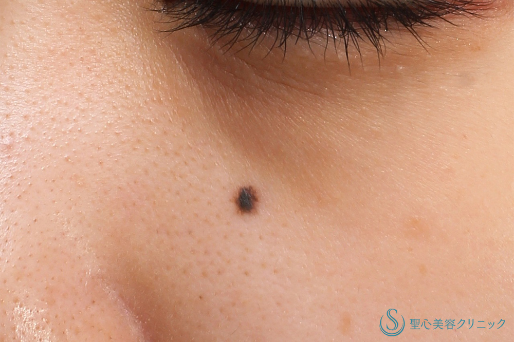 【20代女性・目の下のホクロ】電気凝固法（ホクロ・イボ）（2年後） Before 