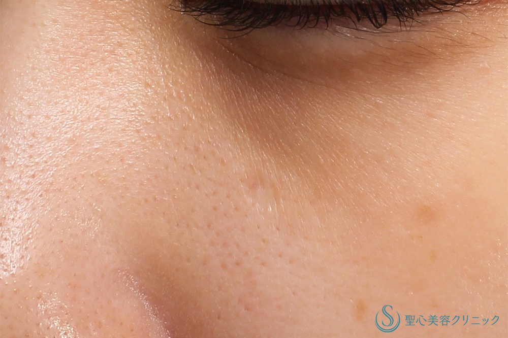 【20代女性・目の下のホクロ】電気凝固法（ホクロ・イボ）（2年後） After 