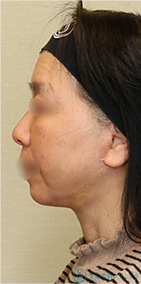 【60代女性・しっかりリフトアップ】フェイスリフト＋脂肪吸引（頬＋顎）＋リガメント処理（1ヶ月後） After 