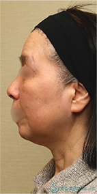 【60代女性・しっかりリフトアップ】フェイスリフト＋脂肪吸引（頬＋顎）＋リガメント処理（1ヶ月後） Before 