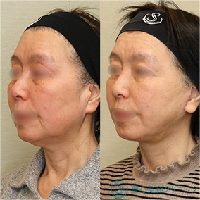 【60代女性・しっかりリフトアップ】フェイスリフト＋脂肪吸引（頬＋顎）＋リガメント処理（1ヶ月後） After 名古屋院