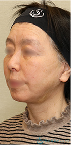 【60代女性・しっかりリフトアップ】フェイスリフト＋脂肪吸引（頬＋顎）＋リガメント処理（1ヶ月後） After 