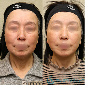 【60代女性・しっかりリフトアップ】フェイスリフト＋脂肪吸引（頬＋顎）＋リガメント処理（1ヶ月後） After 名古屋院