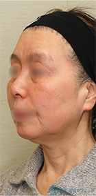 【60代女性・しっかりリフトアップ】フェイスリフト＋脂肪吸引（頬＋顎）＋リガメント処理（1ヶ月後） Before 