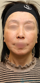 【60代女性・しっかりリフトアップ】フェイスリフト＋脂肪吸引（頬＋顎）＋リガメント処理（1ヶ月後） After 