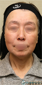 【60代女性・しっかりリフトアップ】フェイスリフト＋脂肪吸引（頬＋顎）＋リガメント処理（1ヶ月後） Before 