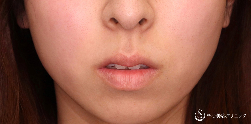 【20代女性・人中をバランスよくできるだけ短くしたい！！】プレミアムリップリフト（プレミアム人中短縮術）（7ヶ月後） Before 