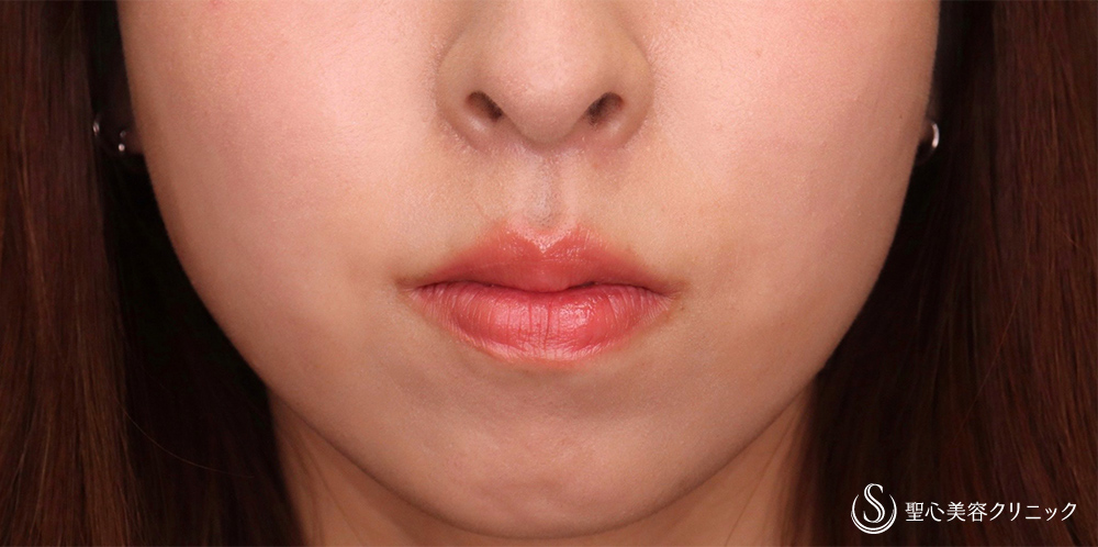 【20代女性・人中をバランスよくできるだけ短くしたい！！】プレミアムリップリフト（プレミアム人中短縮術）（7ヶ月後） After 