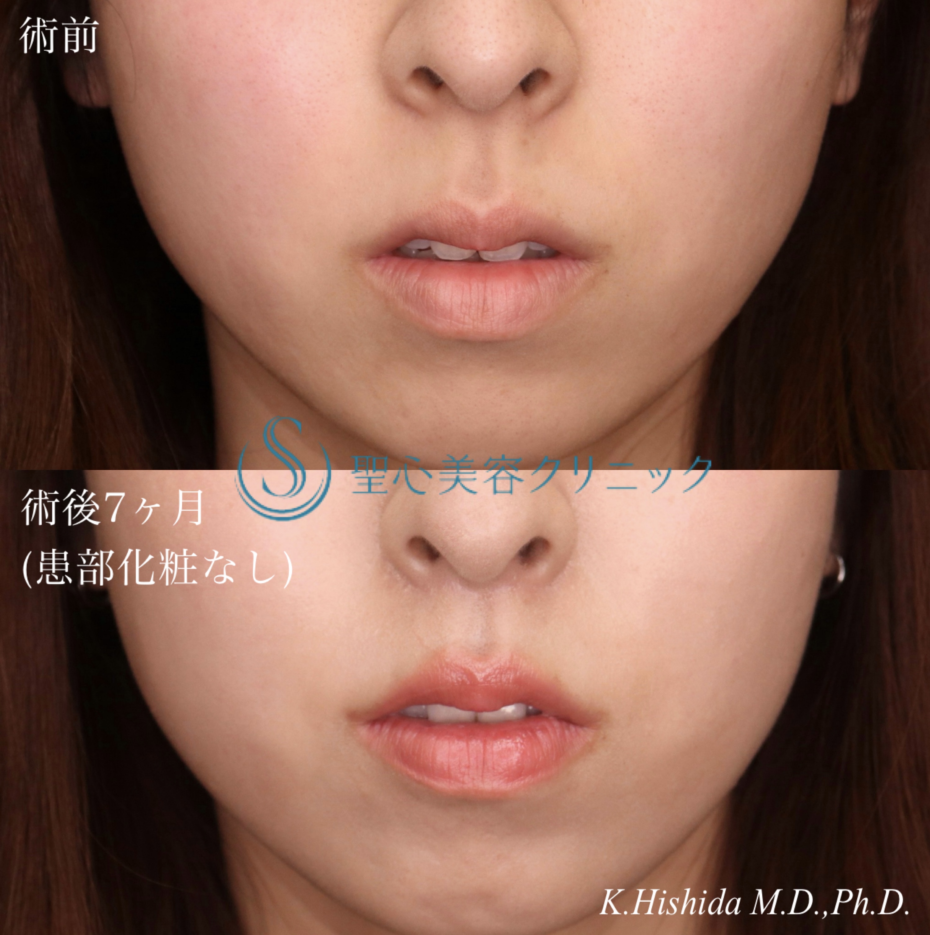 【20代女性・人中をバランスよくできるだけ短くしたい！！】プレミアムリップリフト（プレミアム人中短縮術）（7ヶ月後） After 
