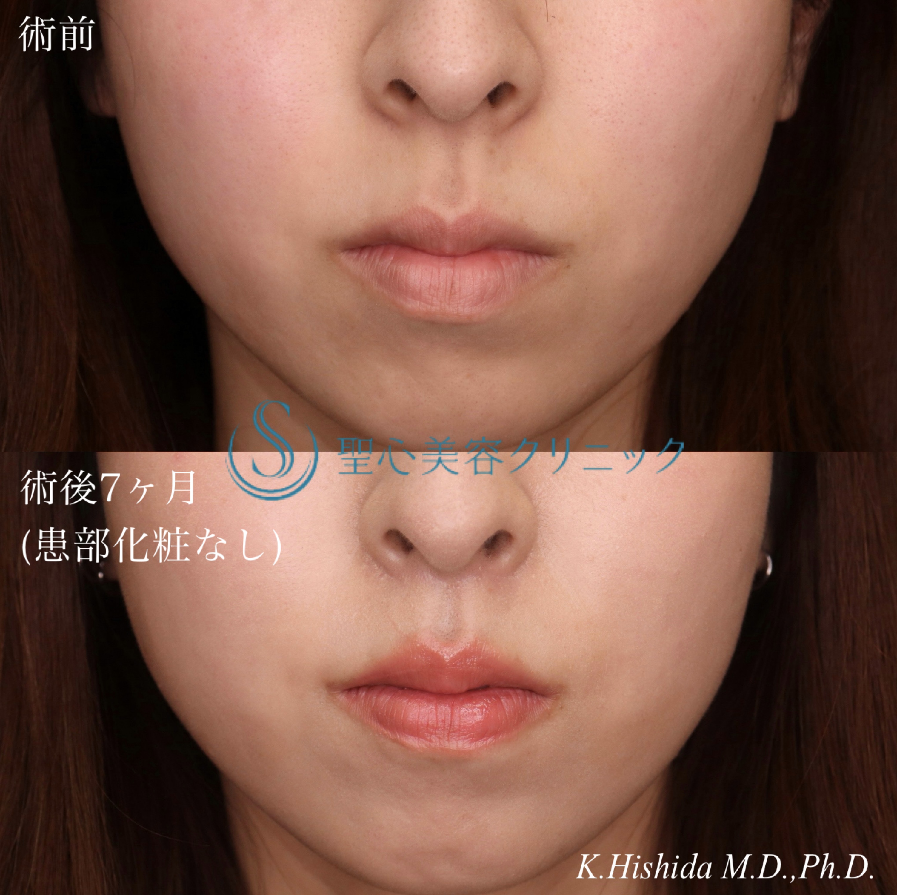 【20代女性・人中をバランスよくできるだけ短くしたい！！】プレミアムリップリフト（プレミアム人中短縮術）（7ヶ月後） After 