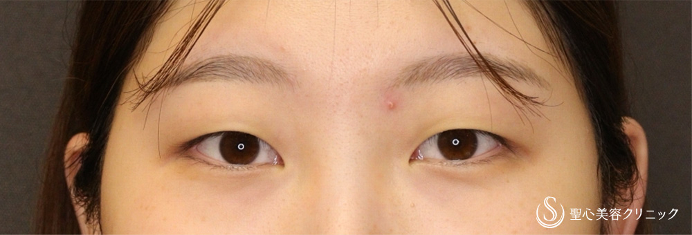 【20代女性・柔らかな魅力ある末広二重に】二重術（埋没法）：マイクロメソッド+α（二重埋没法）（1ヶ月後） Before 