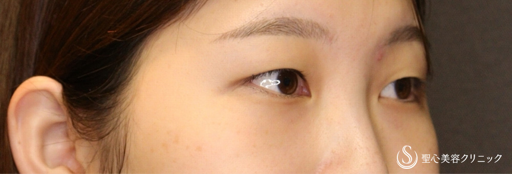 【20代女性・柔らかな魅力ある末広二重に】二重術（埋没法）：マイクロメソッド+α（二重埋没法）（1ヶ月後） Before 