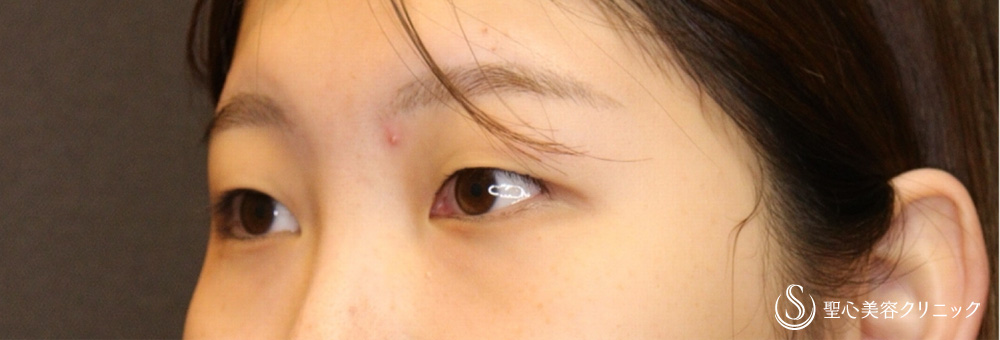 【20代女性・柔らかな魅力ある末広二重に】二重術（埋没法）：マイクロメソッド+α（二重埋没法）（1ヶ月後） Before 