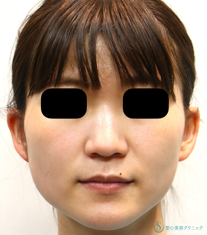 【20代女性・エラボトックスで小顔に】ボツリヌストキシン注入（注射）（1ヶ月後） Before 
