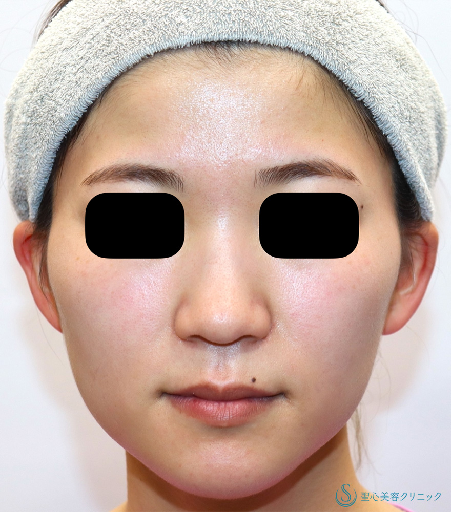 【20代女性・エラボトックスで小顔に】ボツリヌストキシン注入（注射）（1ヶ月後） After 