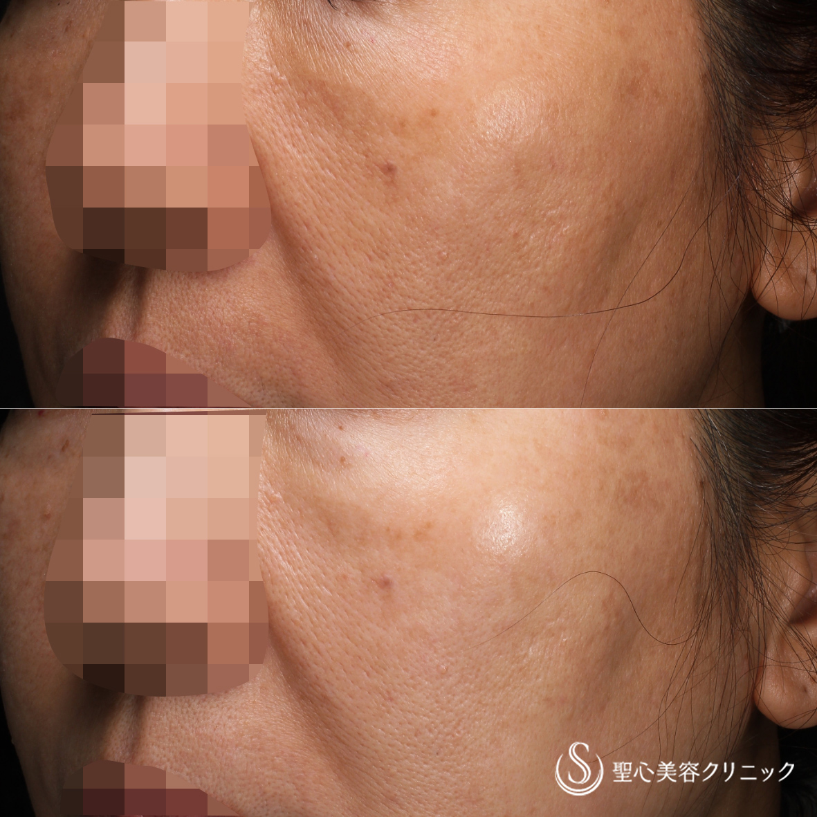 【50代女性・ダウンタイムのない美肌治療】CellecV（セレックV）＋レタッチピール（2年後） After 名古屋院