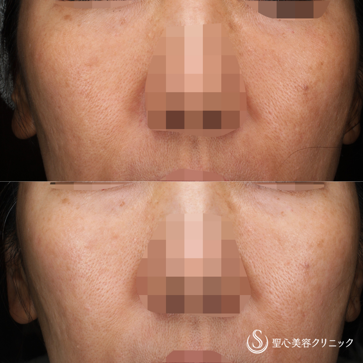 【50代女性・ダウンタイムのない美肌治療】CellecV（セレックV）＋レタッチピール（2年後） After 名古屋院