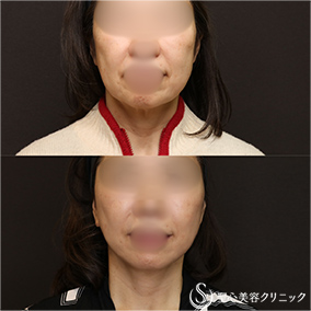 【60代女性・人気のリフトアップ】フェイスリフト＋脂肪吸引（頬＋顎）＋リガメント処置（1ヶ月後） After 名古屋院