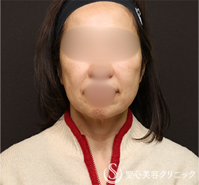 【60代女性・人気のリフトアップ】フェイスリフト＋脂肪吸引（頬＋顎）＋リガメント処置（1ヶ月後） Before 