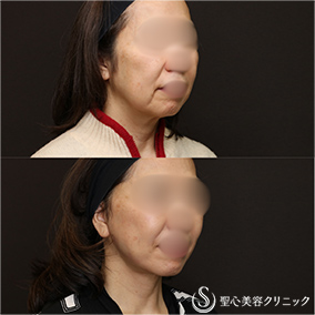 【60代女性・人気のリフトアップ】フェイスリフト＋脂肪吸引（頬＋顎）＋リガメント処置（1ヶ月後） After 名古屋院