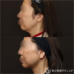 【60代女性・人気のリフトアップ】フェイスリフト＋脂肪吸引（頬＋顎）＋リガメント処置（1ヶ月後） After 名古屋院