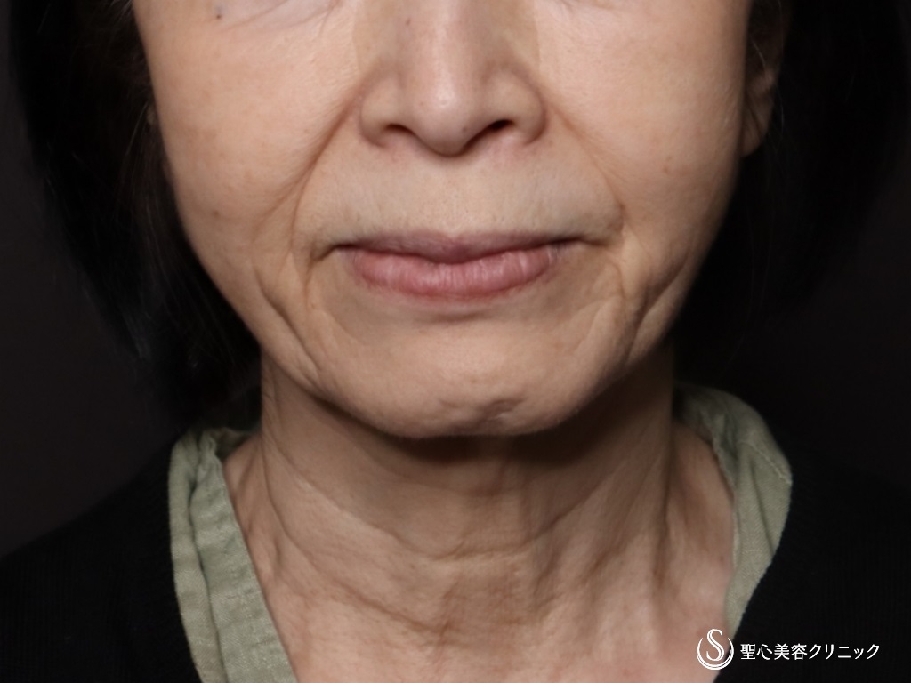【70代女性・フェイスラインがスッキリ】プレミアムミニリフト＋ネックリフト＋脂肪吸引（頬顎下）（術後1ヶ月） Before 