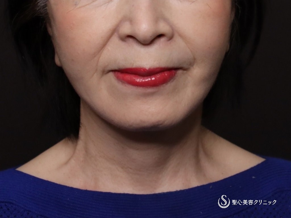【70代女性・フェイスラインがスッキリ】プレミアムミニリフト＋ネックリフト＋脂肪吸引（頬顎下）（術後1ヶ月） After 