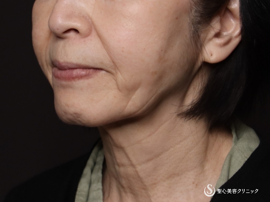 【70代女性・フェイスラインがスッキリ】プレミアムミニリフト＋ネックリフト＋脂肪吸引（頬顎下）（術後1ヶ月） Before 
