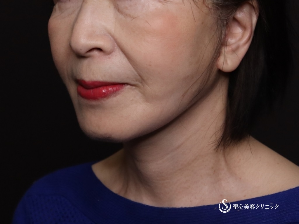 【70代女性・フェイスラインがスッキリ】プレミアムミニリフト＋ネックリフト＋脂肪吸引（頬顎下）（術後1ヶ月） After 