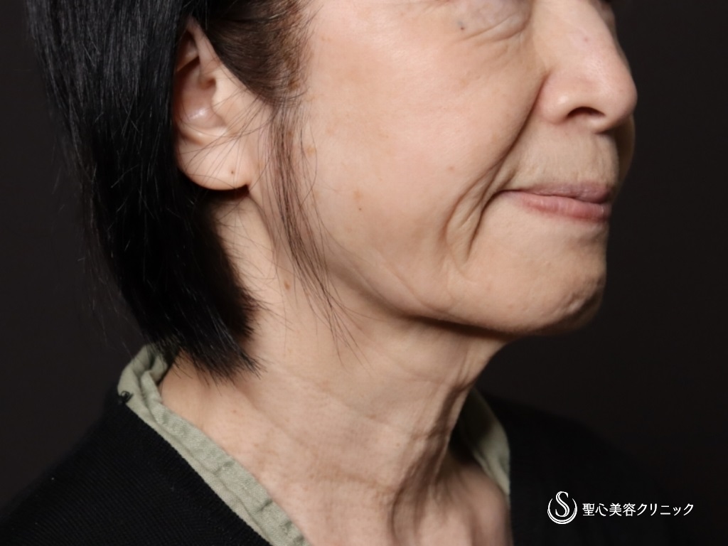 【70代女性・フェイスラインがスッキリ】プレミアムミニリフト＋ネックリフト＋脂肪吸引（頬顎下）（術後1ヶ月） Before 