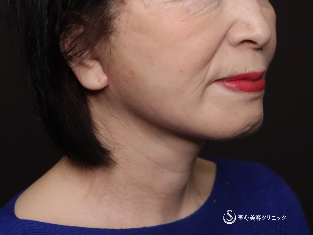【70代女性・フェイスラインがスッキリ】プレミアムミニリフト＋ネックリフト＋脂肪吸引（頬顎下）（術後1ヶ月） After 
