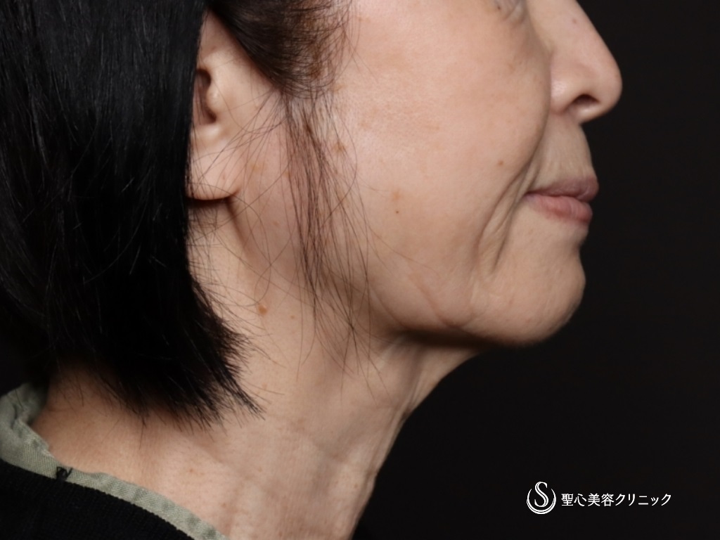 【70代女性・フェイスラインがスッキリ】プレミアムミニリフト＋ネックリフト＋脂肪吸引（頬顎下）（術後1ヶ月） Before 