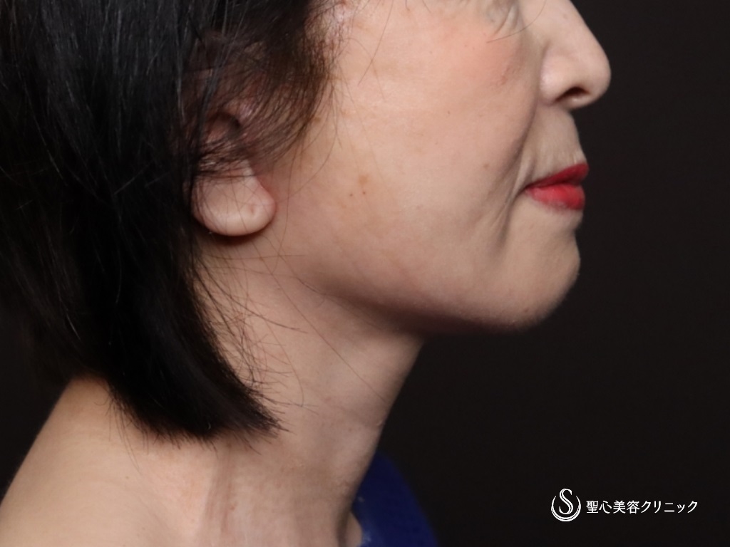 【70代女性・フェイスラインがスッキリ】プレミアムミニリフト＋ネックリフト＋脂肪吸引（頬顎下）（術後1ヶ月） After 