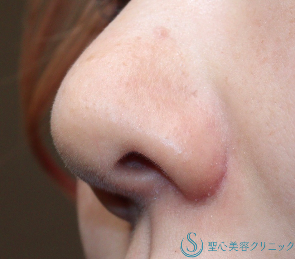 【30代女性・小鼻を小さく】小鼻縮小（術後2ヶ月） After 