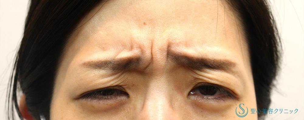 【30代女性・眉間ボトックス（意外な効果も？）】眉間ボツリヌストキシン注入（注射）（1ヶ月後） Before 