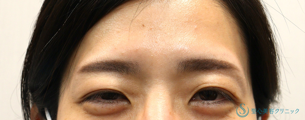 【30代女性・眉間ボトックス（意外な効果も？）】眉間ボツリヌストキシン注入（注射）（1ヶ月後） After 