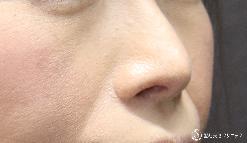【40代女性・他院手術後修正＋正面から鼻の穴を見えにくく】鼻孔縁下降術（1ヶ月後） After 