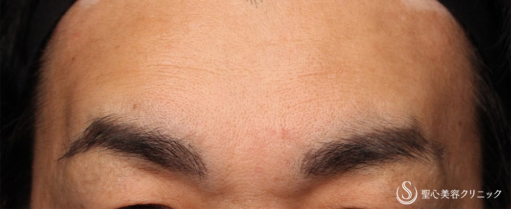 【40代男性・額＋眉間のしわ】プレミアムPRP皮膚再生療法（3ヶ月後） After 