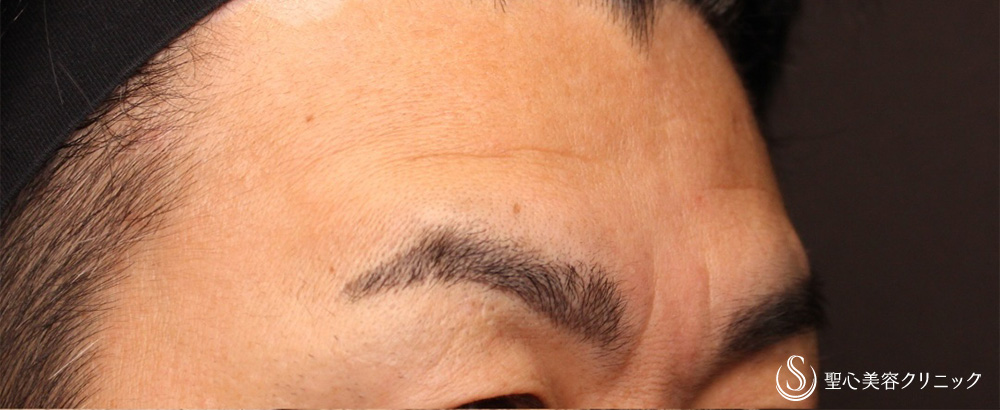 【40代男性・額＋眉間のしわ】プレミアムPRP皮膚再生療法（3ヶ月後） Before 