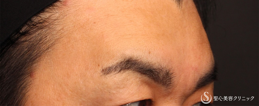 【40代男性・額＋眉間のしわ】プレミアムPRP皮膚再生療法（3ヶ月後） After 