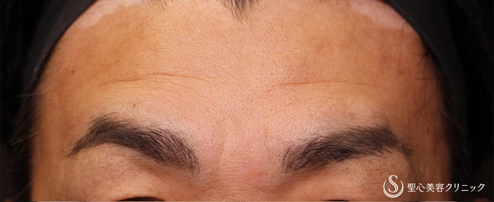 【40代男性・額＋眉間のしわ】プレミアムPRP皮膚再生療法（3ヶ月後） Before 