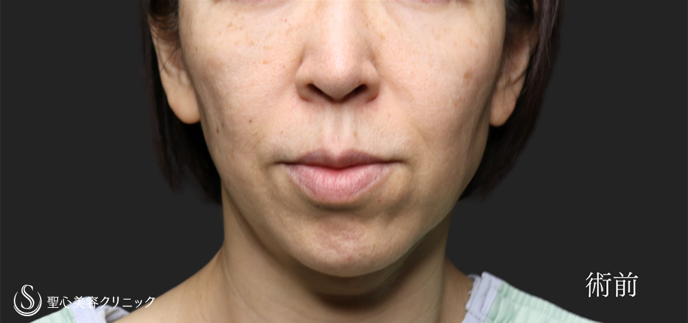 【40代女性・フェイスリフトで圧倒的な引き上げを】フェイスリフト（1ヶ月後） Before 