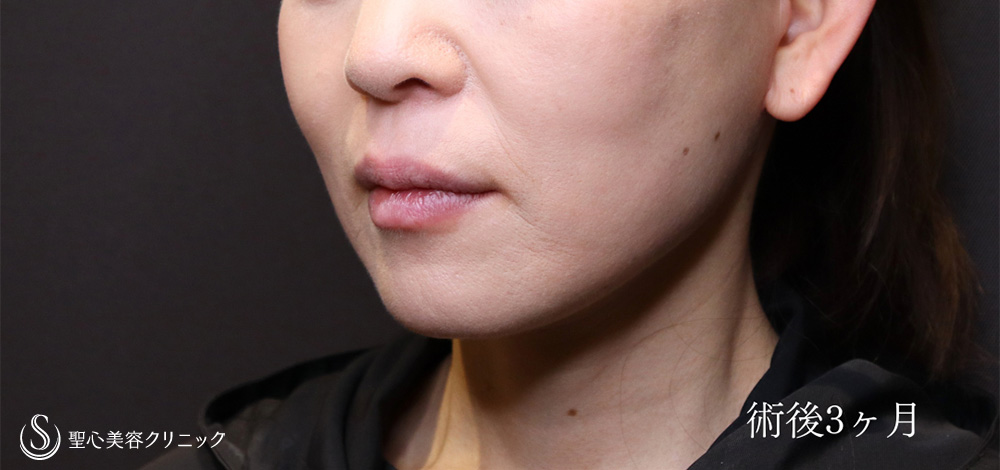【50代女性・フェイスラインをシャープに】フェイスリフト＋脂肪吸引（頬＋顎）＋リガメント処置（3ヶ月後） After 