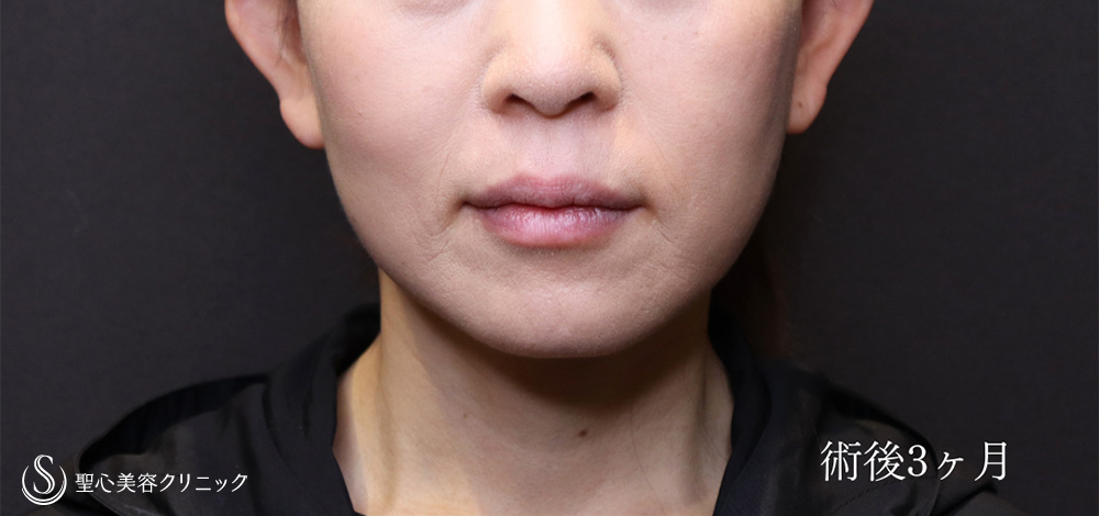 【50代女性・フェイスラインをシャープに】フェイスリフト＋脂肪吸引（頬＋顎）＋リガメント処置（3ヶ月後） After 