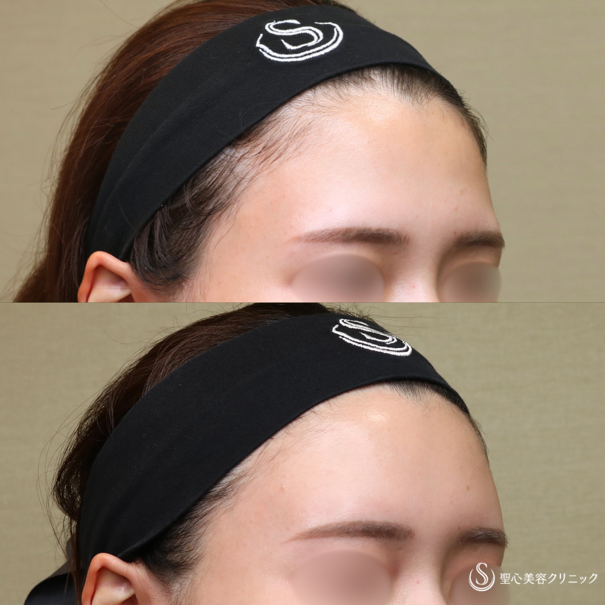 【20代女性・自然な立体感】プレミアムPRP皮膚再生療法（額）（6ヶ月後） After 名古屋院