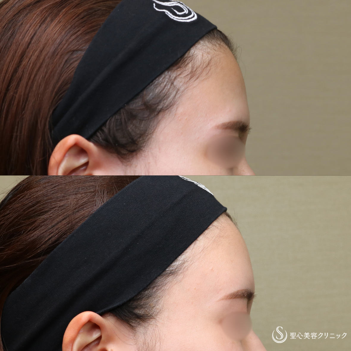 【20代女性・自然な立体感】プレミアムPRP皮膚再生療法（額）（6ヶ月後） After 名古屋院