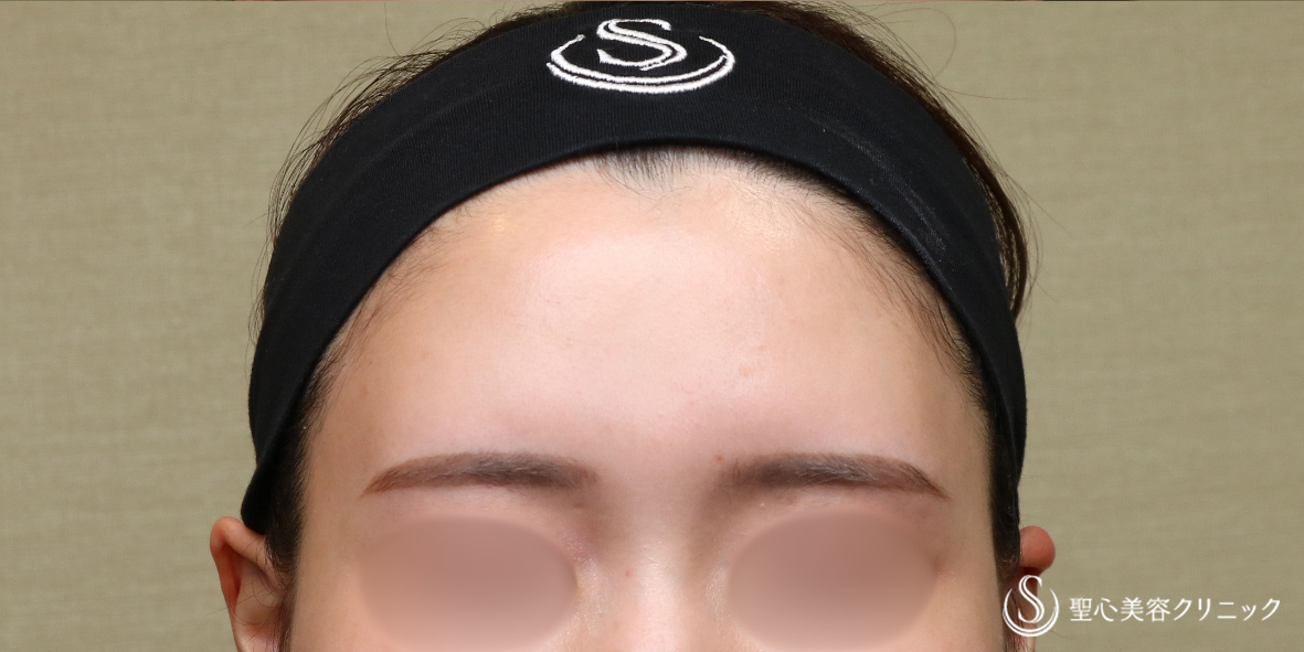【20代女性・自然な立体感】プレミアムPRP皮膚再生療法（額）（6ヶ月後） After 